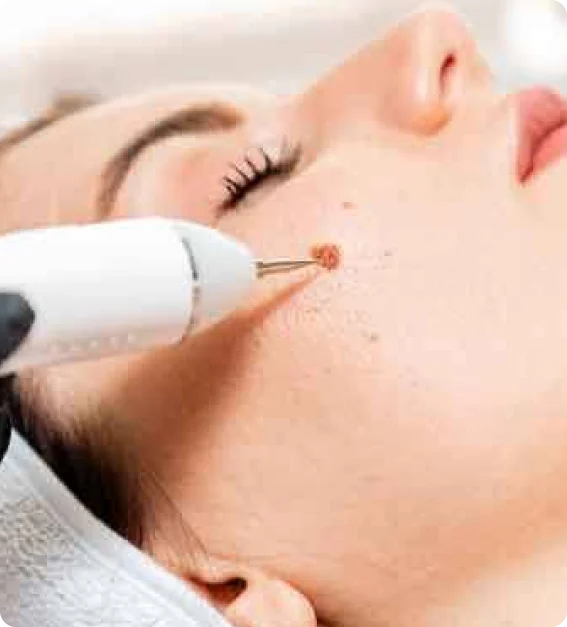 Moles & tag removal