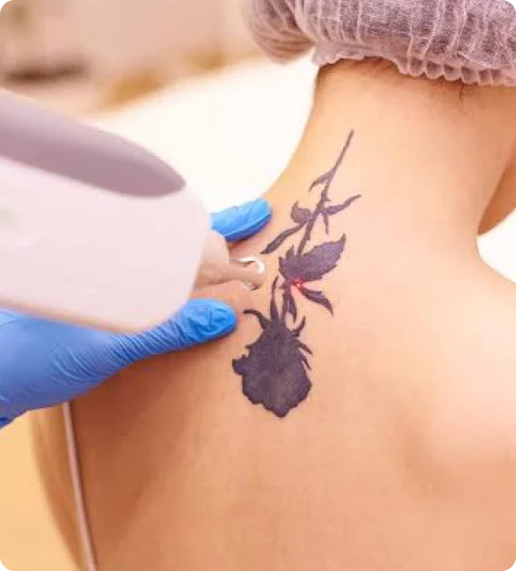 Tattoo removal