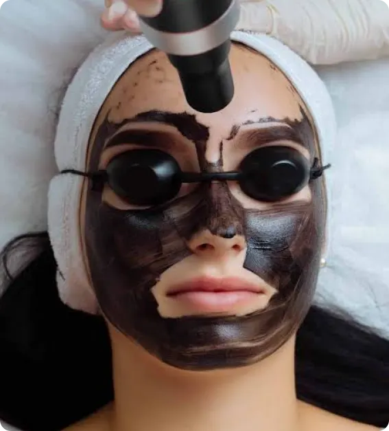 Carbon facial