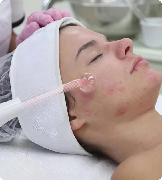 Acne facial